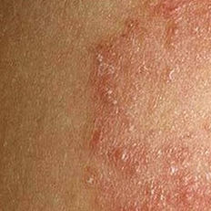 Avaderma Skin & Hair Clinic - Herpes Zoster (Shingles)